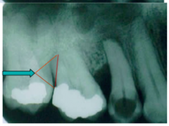 shadow over medial or distal of MAXILLARY molars. 
Indicates class II or Class III furcation
However, no furcation arrow does not mean no class II or Class III present