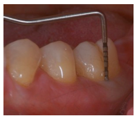 The probing depth at this location is 7mm, and the gingival margin is at/near the CEJ. Do you expect a furcation involvement at this location?