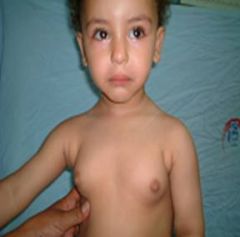 precocious puberty is associated with pathology of the

a. fomix
b. hippocampus
c. hypothalamus
d.lateral geniculate body
