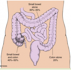 can effect anywhere in GI tract
ulcerations are linear
effect all layers of the GI tract so can cause fistulas
small bowel involvement and chronic presentation can cause malnutrition