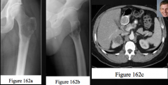 Patient with proximal thigh pain with weight bearing has the following X ray and CT findings. What is the appropriate step prior to operative treatment?