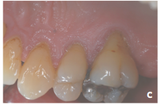 -->aggressive tooth brushing mostly in thin biotype 
>Tooth malposition 
>Angle of root in bone (lingual inclination of palatal root in Max molar) 
>High muscle attachment and frenal pull 
>Iatrogenic related to restorative tx (RPD, overhang, ...