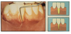 Marginal tissue recession extends to or beyond the MGJ 
No loss of bone or soft tissue of interdental area