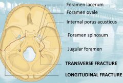 LONGITUDINAL: 
• The fracture runs along the external auditory canal and the anterior border of the petrous pyramid 
• The most common fracture 
• COMPLICATIONS: 
- conductive hearing loss 
- peripheral facial palsy ( -> TYMPANIC OR MAS...