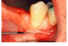 Push the adjacent mucosa coronally with a dull instrument. In general, the amount of gingiva is considered insufficient when stretching of the lip or cheek induces movement of the free gingival margin
