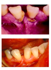 A frenum becomes a problem if the attachment is too close to marginal gingiva