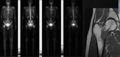 Bone scan and MRI reveal the right proximal femoral lesion in a patient with hip pain with ambulation. What is the best next step?