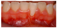 13 year old female presents with the above mucogingival appearance. What is the ideal treatment?