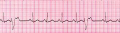 A 52 year woman with a history of hypertension and type II diabetes presents to the ER complaining of chest pain for the past hour, radiating into her jaw. She complains of shortness of breath. The patient is placed on a cardiac monitor.
Evaluatio...