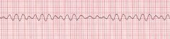 In ACLS, what action immediately follows each shock?