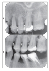 >The alveolar crest height is accurately depicted as possible 
>The relation of CEJ to alveolar crest can be accurately determined 
>The presence of vertical bony defect can be demonstrated more precisely than with PAs
 Note the difference bone...