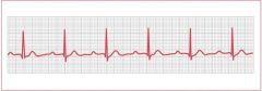The patient has return of spontaneous circulation, with a blood pressure of 90/60, with no spontaneous breathing. The patient is hooked to the ventilator. The rhythm strip reveals:
