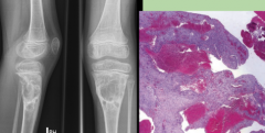 This bone lesion's histology is similar in appearance to that of Telangiectatic osteosarcoma, but radiographic appearance is consistent with what benign bone lesion?