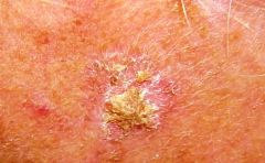 crumbly, yellow-white scaly crusts on sun-exposed skin from dysplastic intra-epidermal proliferation of atypical keratinocytes