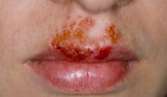 around nose and face, honey colored crusts on erythematous base
- staph aureus +/- strep pyogenes