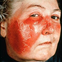 unilateral face (usually) with fever and increase wcc
- caused