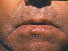 What is on this guy's lip?