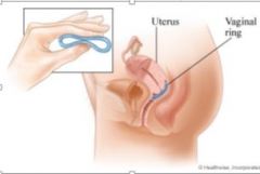"Vaginal rings

•Silasticcylinder packed with ethinylesterdioland a progestin, etonogestrel

•The steroids are release with zero order kinetics and remains in place for 21 days•After removal menses may occur (7days)"