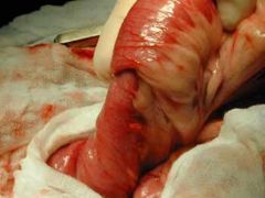 intussusception (chronic diarrhoea)
treated surgically