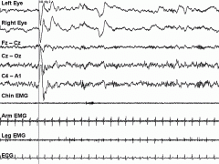 Waveforms with a well-delineated negative sharp wave immediately followed by a positive component with a duration of 0.5 seconds or longer, usually maximal when recorded over frontal derivations