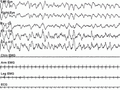 High-amplitude synchronized EEG activity with a frequency of 0.5 to 2.0 Hz