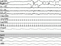 Asynchronous, low-amplitude, mixed-frequency EEG activity; rapid eye movements