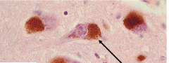 Neuromelanin-containing neurons in brainstem (substantia nigra, locus ceruleus, motor nucleus of vagus)