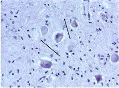Lipofuscin - accumulates in neuronal cytoplasm with age.  Gold and brown pigment. Occurs with all neurons with age.