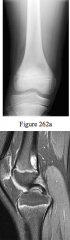 10 year old girl with activity related bilateral knee pain. MR is shown. What is the best treatment?