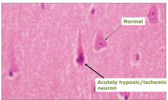 Eosinophilic Neurons (acute hypoxia/ischemia)