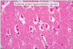 Scattered acutely hypoxic/ischemic neurons