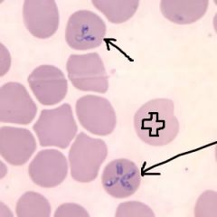 Disease:
Babesiosis
--> fever and hemolytic anemia
-->predominantly in northeastern US
-->asplenia ( higher risk of severity of disease)

Transmission:
Ixodes tick (same as Borrelia burgdoferi of Lyme)

Diagnosis:
Blood smear --> ring form 
--> M...