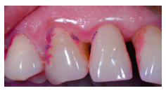 What would you prescribe to the patient to clean the interdental space between 13 and 14?
