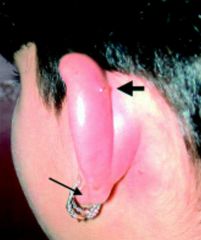 Perikondritis adalah kelainan pada telinga yang disebabkan oleh