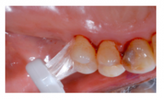 To improve access to distal surfaces of posterior molars, tipped, rotated or displaced teeth (ie. missing 6,7,8 and the distal of the 5 has root exposure 
To clean around and under FPD, pontic or ortho appliances 
To clean around teeth affected ...