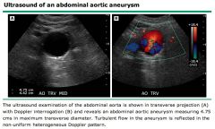 Abdominal Ultrasound to look for AAA