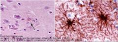 LT - Fibrillary Reactive Astrocytosi
RT - GFAP: Fibrillary reactive astrocytosis