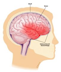 what CSF findings would you see in a case of subarachnoid hemorrhage