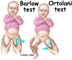 i. Barlow's test
ii. Ortolani's test