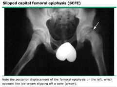 slipped capital femoral epiphysis (SCFE)

AP and frog leg lateral is the imaging studies to order