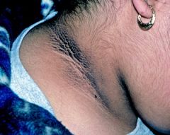 A 60-yr old obese patient presents with dirty, velvety patches on the back of the neck ---> what is the diagnosis and what is the initial workup?