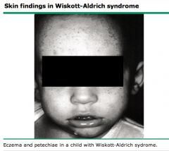 Wiscott-Aldrich Syndrome