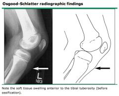 Osgood- Schlatter Disease