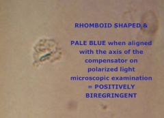 Joint aspirate reveals rhomboid shaped, positively birefringent crystals --> what is the dx?