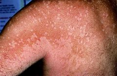 What is the causitive agent in this skin condition?

Hypopigmented macules and patches are scattered on the shoulder and arm of this patient.