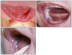A 25 year old male presents with white plaques on his tongue and the back of his throat that scrape off with a tongue depressor --> what is the dx? what should he be screened for?