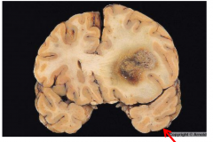Primary Brain Tumor (Glioblastoma)