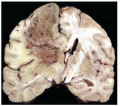 Vasogenic cerebral edema. Malignant brain tumors have extensive associated angiogenesis with microvascular proliferation and poorly formed BBB. Result is extensive vasogenic edema and mass effect.