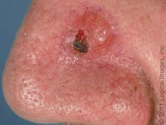 What skin lesion causes a pearly-colored papule with a translucent surface and telangiectasias?