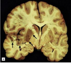 Cytotoxic Edema. Left MCA territory infarct.
Early edema with shift of midline structures from left to right